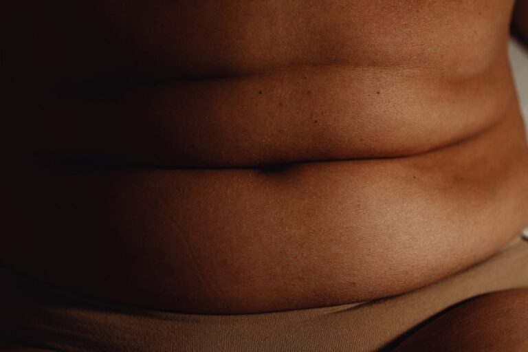 Arañas vasculares abdominales: Soluciones para las venas del abdomen