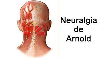 Cefalea por Neuralgia de Arnold: Causas y Tratamiento Efectivo