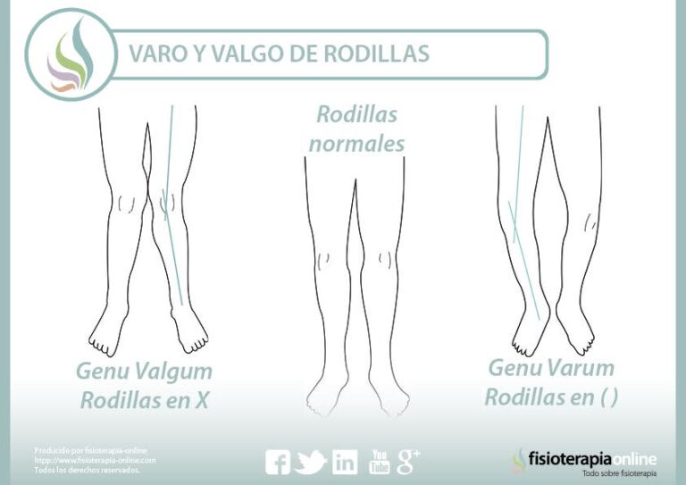 Corrige tus rodillas: Ejercicios para las varas y valgas posturales