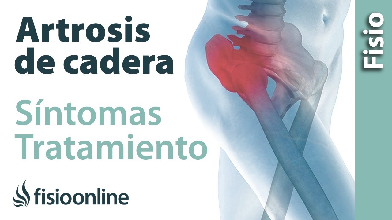 Coxartrosis: Síntomas, diagnóstico y fisioterapia efectiva