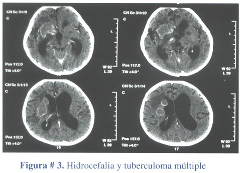 Cuadrigeminos: Tubérculo, Tuberculomas y Meningitis Tuberculosa: Todo lo Que Debes Saber