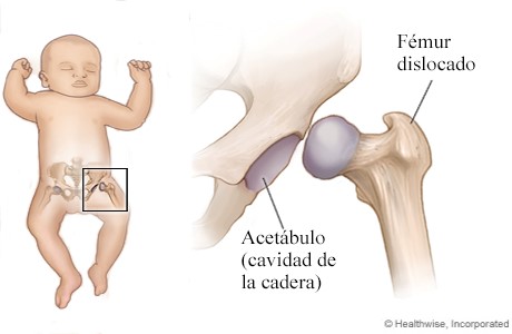 Descubre cómo tratar la luxación congénita de cadera en bebés