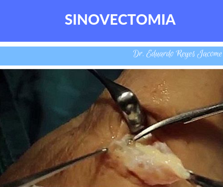 Descubre la eficacia de la sinovectomía: Procedimiento clave para tratar la inflamación articular