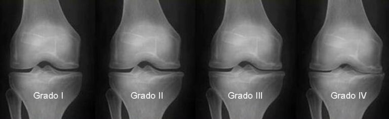Descubre los signos radiológicos de la artrosis de rodilla