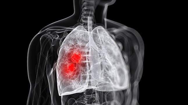 Descubre todo sobre abscesos pulmonares: Síntomas, causas y tratamientos