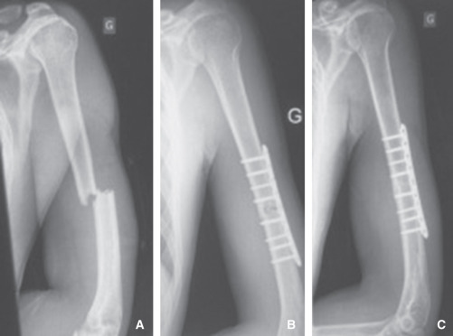 Diafisis humeral: Tratamiento quirúrgico de fracturas recientes