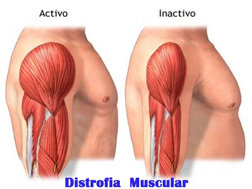 Distrofia Muscular: Causas, Síntomas y Tratamiento