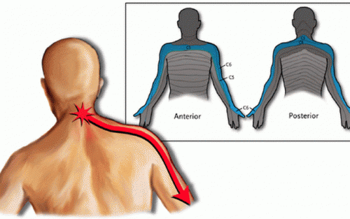 Dolor en cuello, espalda y brazo izquierdo: Causas y soluciones efectivas