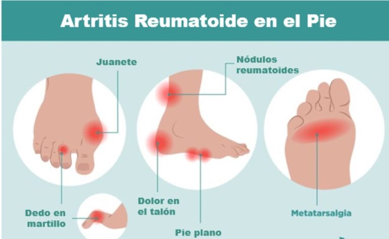 Dolor en las articulaciones de los dedos del pie: causas, síntomas y tratamiento