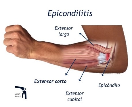 Elimina el dolor del codo de tenista con nuestro tratamiento de epicondilitis