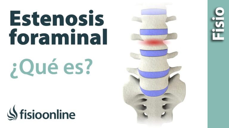 Estenosis foraminal y sensación de ardor: ¿Cómo aliviar el malestar en tus piernas?