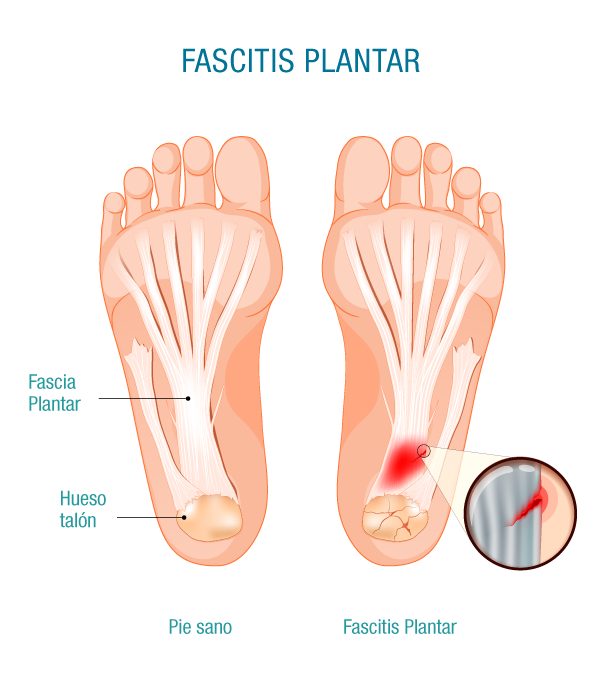 Fascitis plantar post maratón: cómo aliviar el dolor y la inflamación del pie