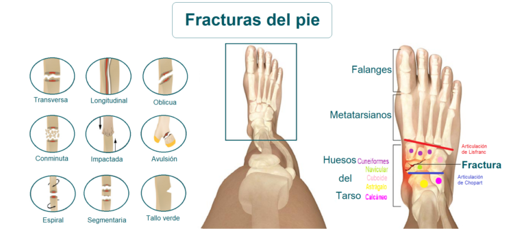 Fracturas de pie: causas, síntomas y tratamiento completo