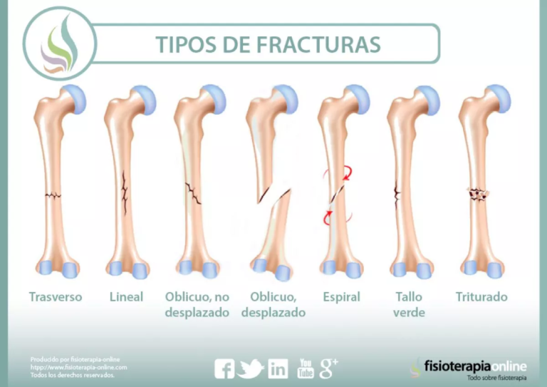 Fracturas óseas: causas, síntomas y tratamiento