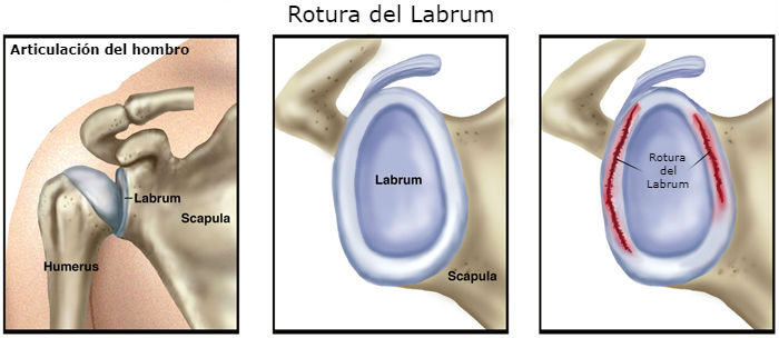 Guía completa de la lesión de Slap en el hombro: Prevención, Diagnóstico y Tratamiento