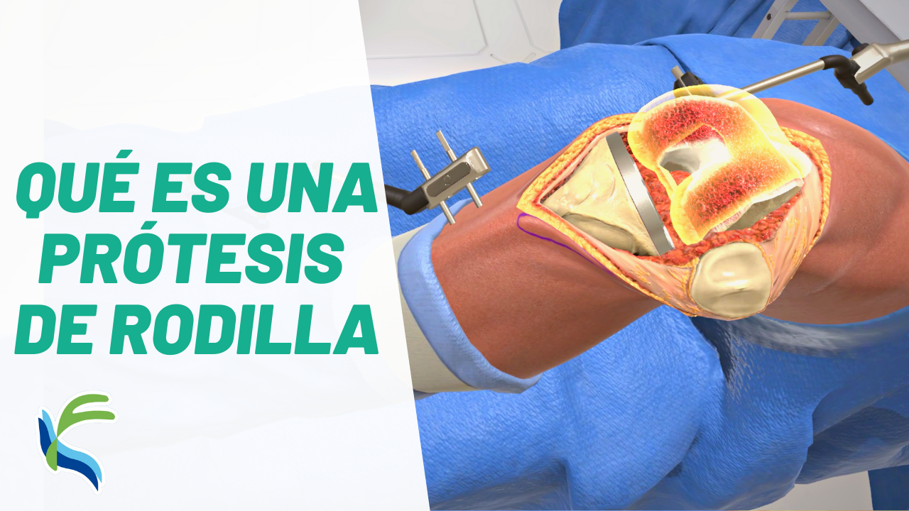 Guía completa: prótesis de rodilla ¡Todo lo que necesitas saber!
