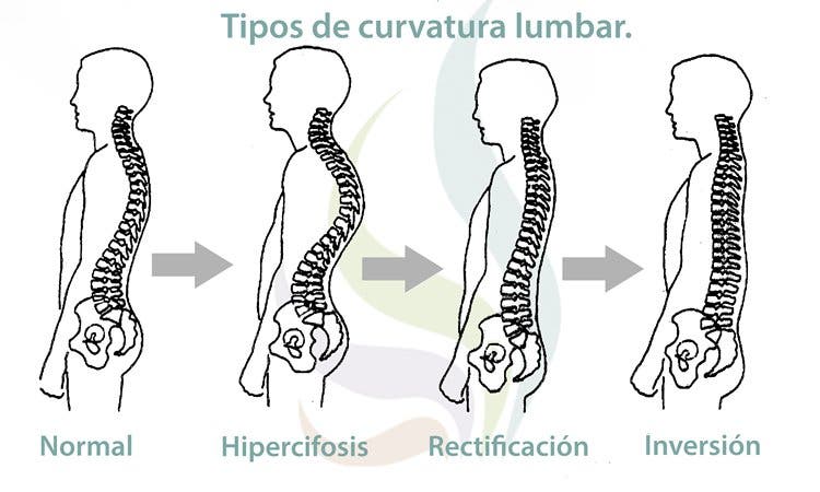 Hiperlordosis: La curvatura excesiva de la columna vertebral