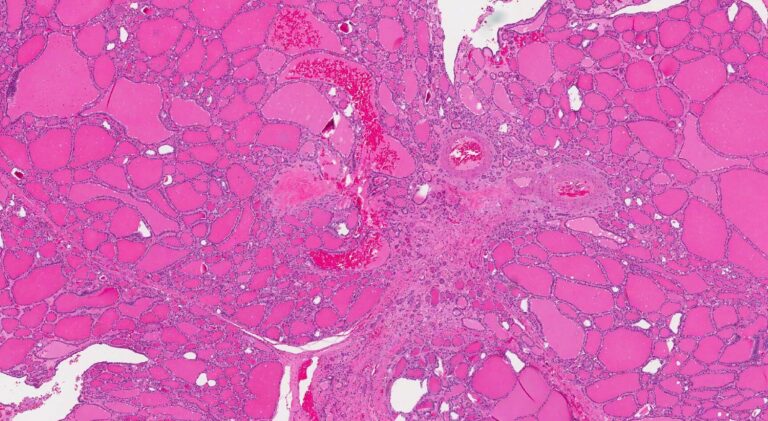 Hiperplasia tiroidea nodular: Diagnóstico y tratamiento de una enfermedad común