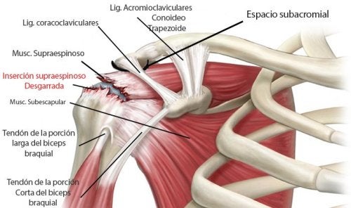 Infiltraciones para tratar la tendinitis de hombro y supraespinoso