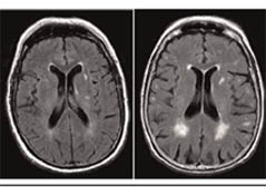 Lesiones de la sustancia blanca en resonancia cerebral: una guía completa