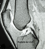 Ligamento cruzado anterior: diagnóstico por resonancia de una rotura