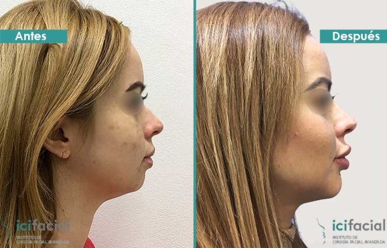 Mentoplastia: mejora tu perfil facial con el cuerpo del mentón