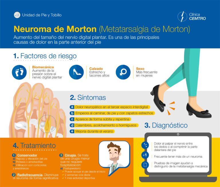 Neuroma de Morton: todo lo que necesitas saber y cómo tratarlo