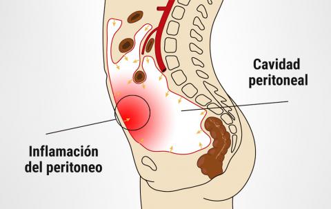 Peritoneum en el Foco: Descubre el Impacto del Péritoine en la Salud