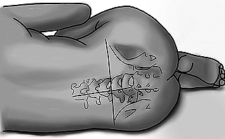 Posición Raquídea: Simplificando la Anestesia Espinal y Epidural