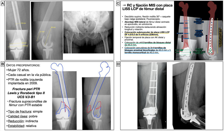 Premaxila: La base terapéutica para el manejo de fracturas en el hueso independiente