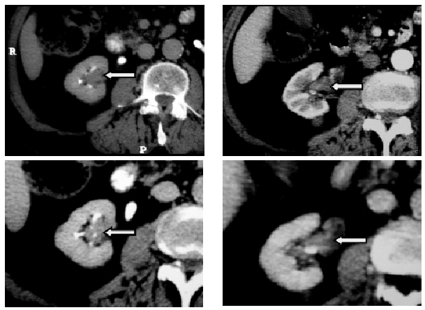 Recidiva tumoral en el meato ureteral izquierdo: Síntomas y causas