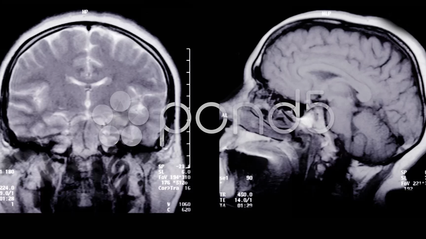 Resonancia Magn tica Cerebral Duraci n De La Exploraci n