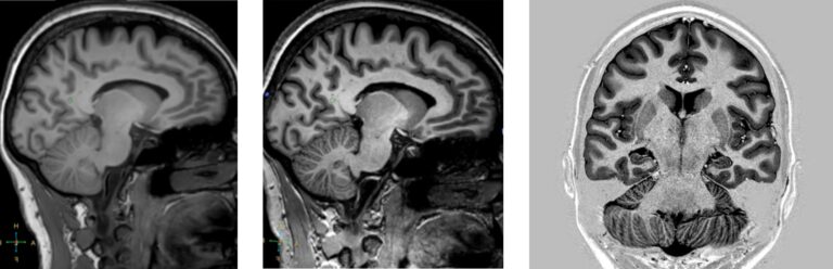 Resonancia Magnética Sin Contraste Cerebral: La Herramienta de Monitorización