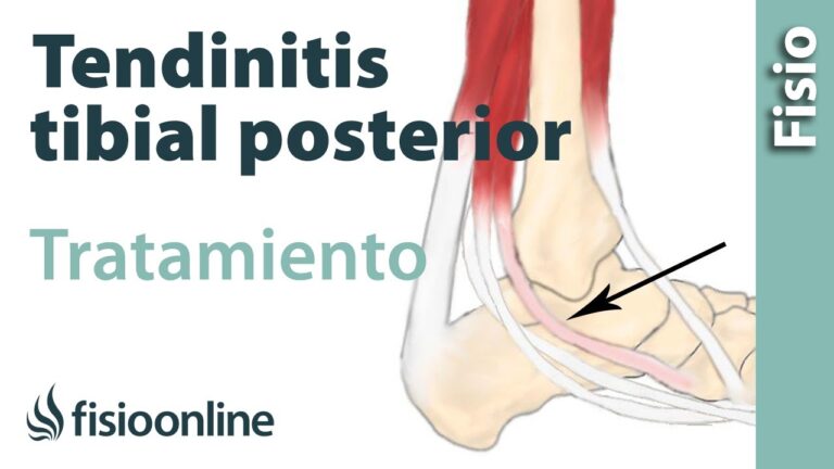 Tendinitis del tibial posterior: causas, síntomas y tratamiento