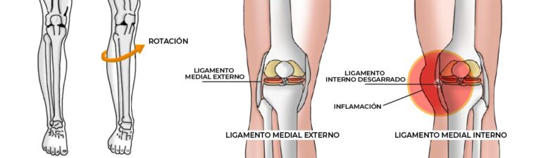 Todo lo que necesitas saber sobre el LLE de la rodilla