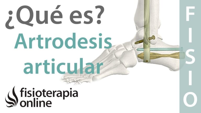 Todo lo que necesitas saber sobre la artrodesis lumbar: indicaciones, riesgos y tratamiento de fisioterapia