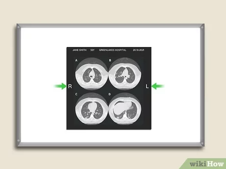 Tomografía abdominal: Cómo leer su informe