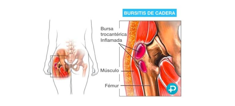 Trocanteritis o bursitis: ¿Por qué me duele la cadera?