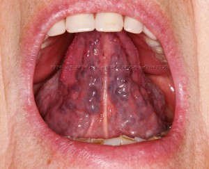 Varices en la lengua: causas y tratamiento