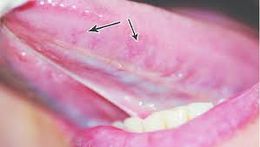 Varices en la lengua: ¿Por qué salen y cómo tratarlas?